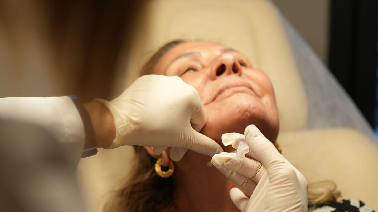 Sculptra Treatment