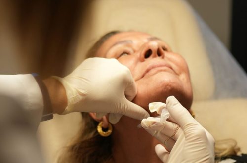 Sculptra Treatment